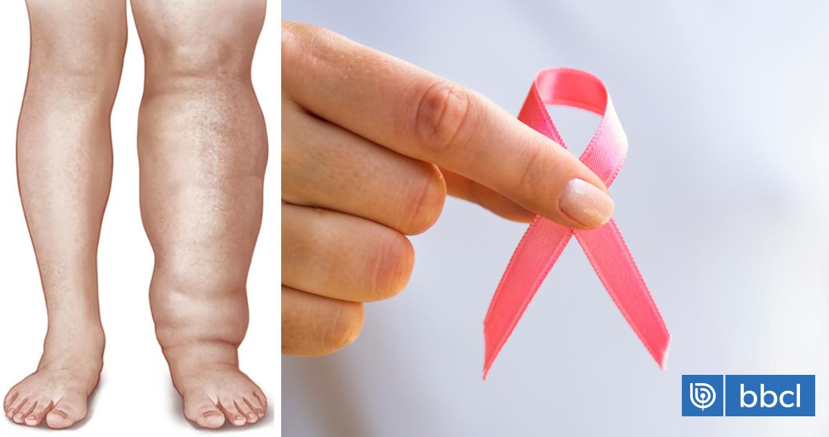Lymphedema: The insidious disease that may occur after breast cancer treatment |...