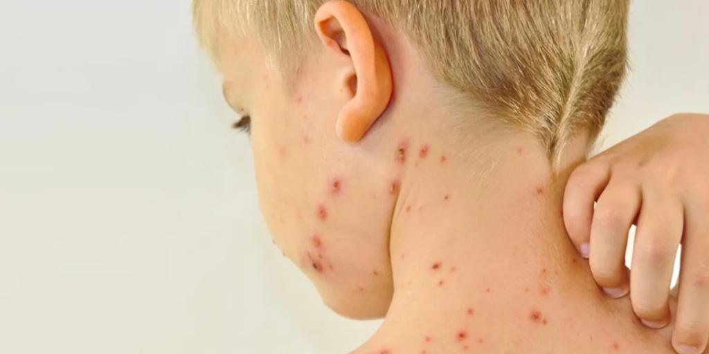 El número de casos de sarampión detectados en el incidente de La Palma ha aumentado a 21.